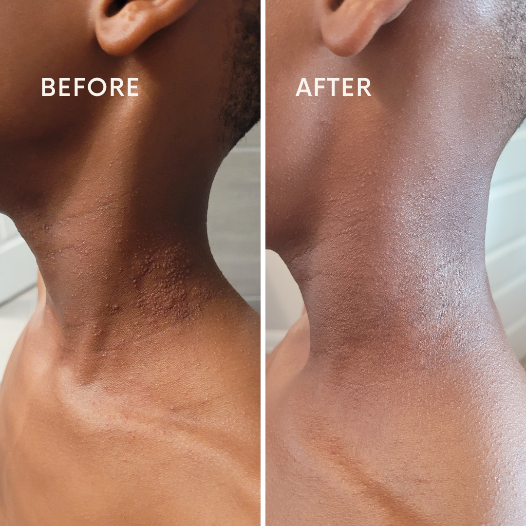 Eczema care before and after results