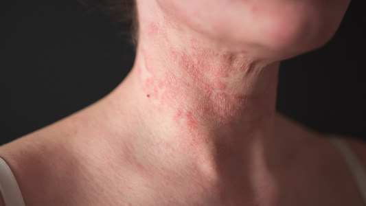 10 Tips to Manage Your Eczema Itch